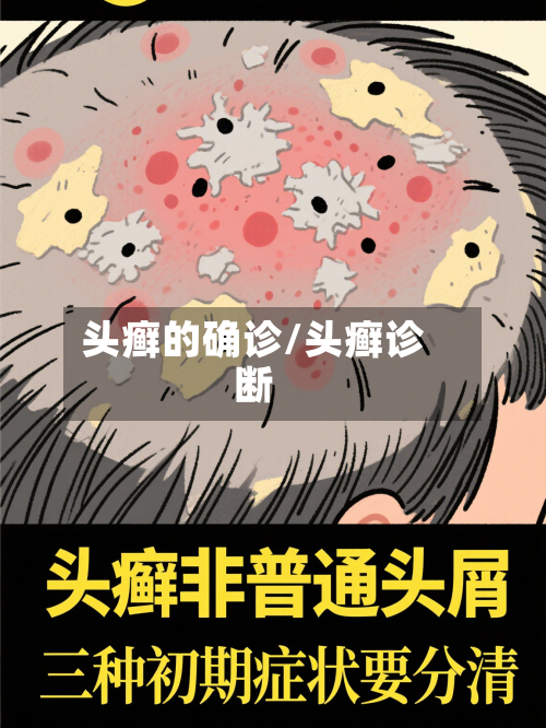 头癣的确诊/头癣诊断