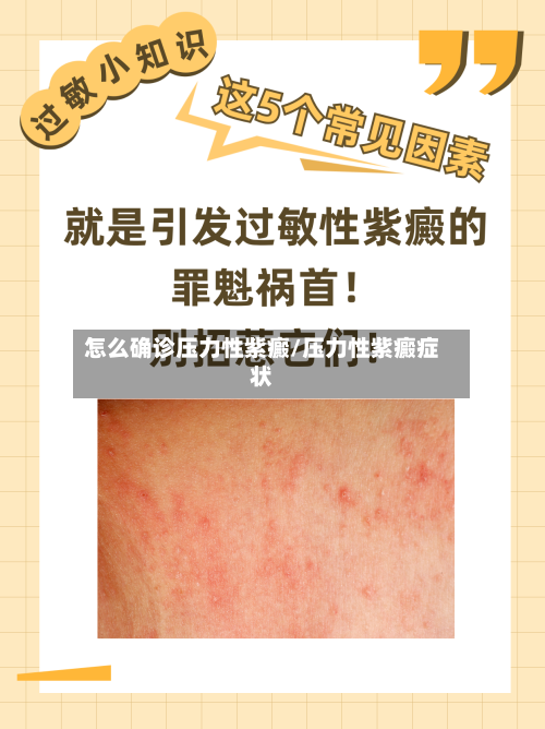 怎么确诊压力性紫癜/压力性紫癜症状