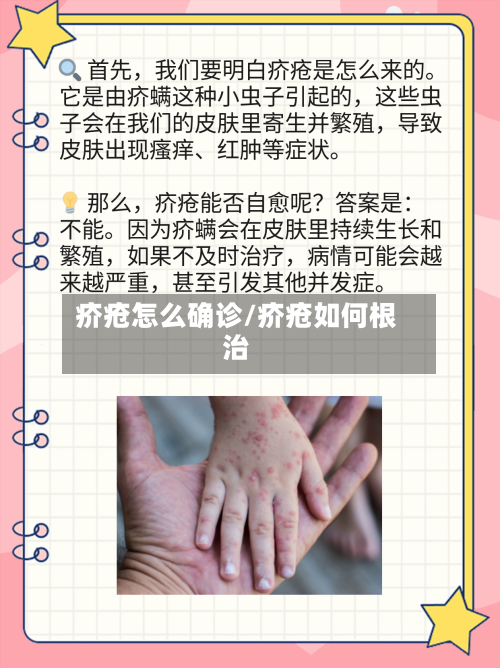 疥疮怎么确诊/疥疮如何根治