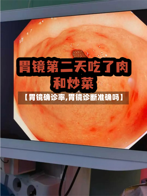 【胃镜确诊率,胃镜诊断准确吗】