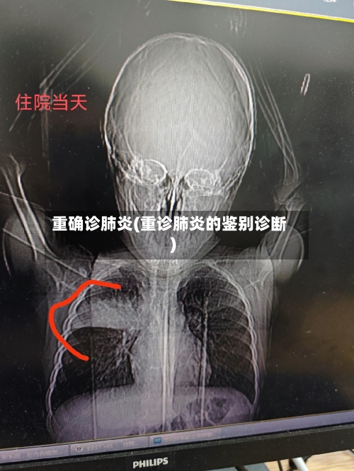 重确诊肺炎(重诊肺炎的鉴别诊断)-第3张图片