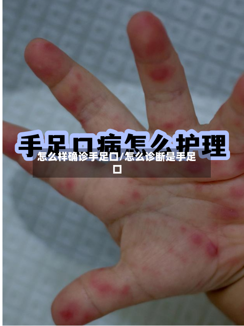 怎么样确诊手足口/怎么诊断是手足口