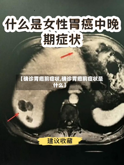 【确诊胃癌前症状,确诊胃癌前症状是什么】