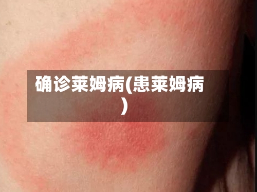 确诊莱姆病(患莱姆病)-第3张图片