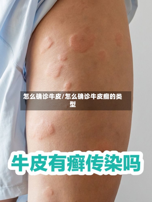 怎么确诊牛皮/怎么确诊牛皮癣的类型-第2张图片