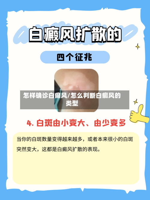 怎样确诊白癫风/怎么判断白癜风的类型-第3张图片