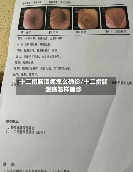 十二指肠溃疡怎么确诊/十二指肠溃疡怎样确诊