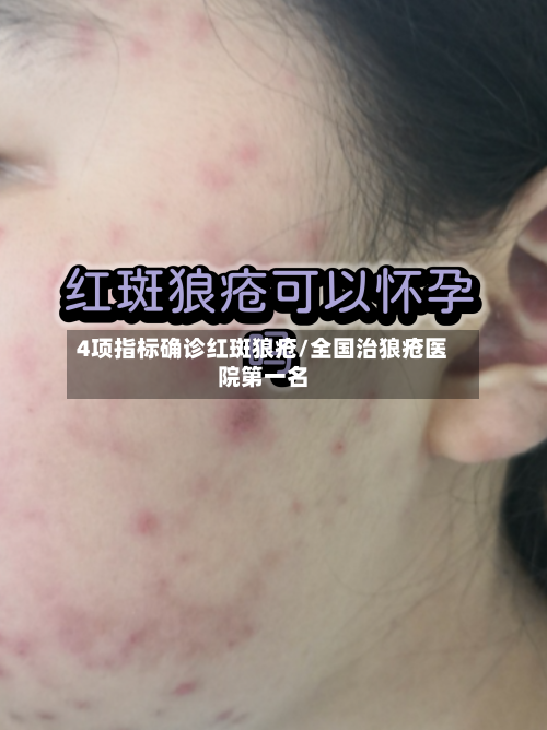 4项指标确诊红斑狼疮/全国治狼疮医院第一名