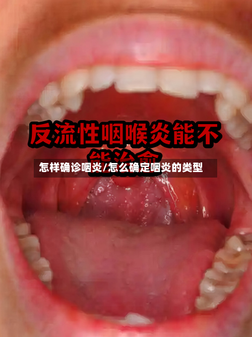 怎样确诊咽炎/怎么确定咽炎的类型